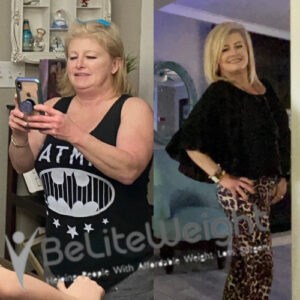 Lissa G= Before And After Gastric Sleeve