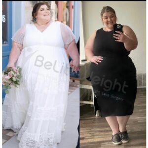 Lauren H= Before And After Gastric Sleeve