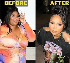 Lizzo weight loss surgery