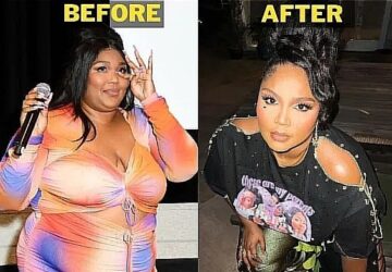 Lizzo weight loss surgery
