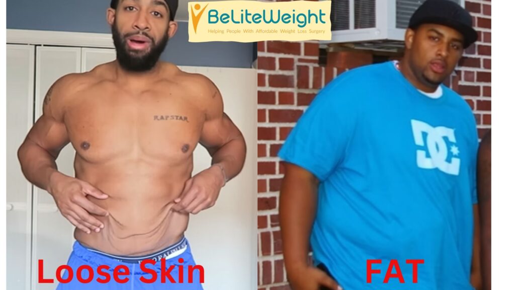 Loose Skin vs Fat Pictures