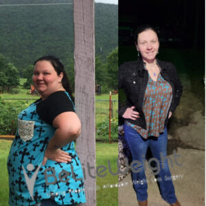 Michelle C= Excess Skin Gastric Sleeve Before And After Skin