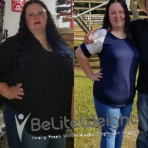 Michelle C= Before And After Gastric Sleeve Surgery