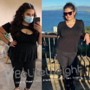 Nicole C= Gastric Sleeve Before And After Skin