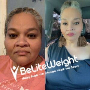 Patsy B= Gastric Sleeve Weight Loss Before And After