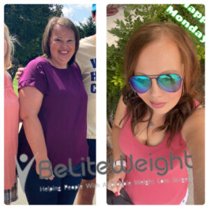 Sabrina C= Gastric Sleeve Before And After Skin