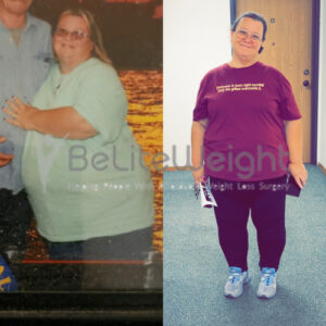 Susan W= Gastric Sleeve Before And After Skin
