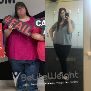 Tracy W= Gastric Sleeve Before And After Pictures