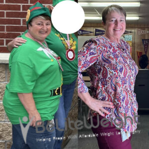 Teresa C= Gastric Sleeve Before And After Skin