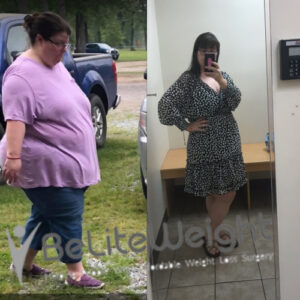 Tracy W= Gastric Sleeve Surgery Before And After