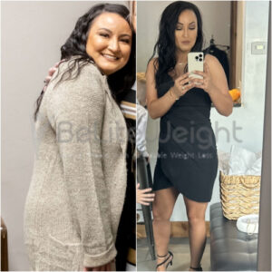 Whitney S= Gastric Sleeve Before And After Skin