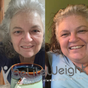 Yvonne J= Gastric Sleeve Before And After 6 Months