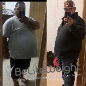 Adan G= Before And After Gastric Bypass