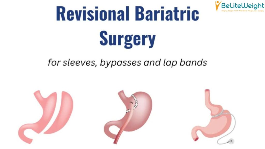 Bariatric Revision Surgeries