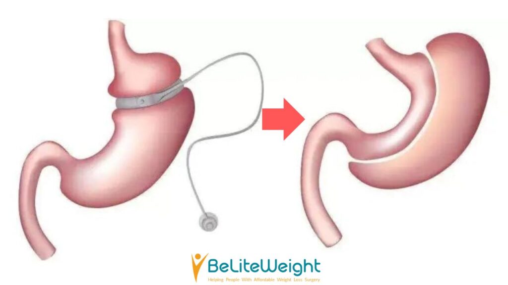 Bariatric Revision Surgery