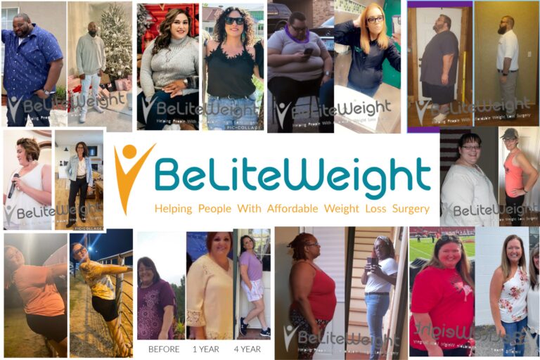 750+ Before and After Gastric Bypass Surgery | Pictures & Stories