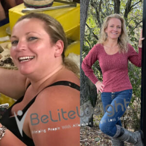 Before And After Gastric Bypass