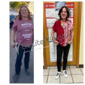 Gastric Bypass Before And After Pictures Skin