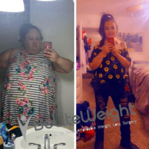 Gastric Bypass Before And After Pictures Skin