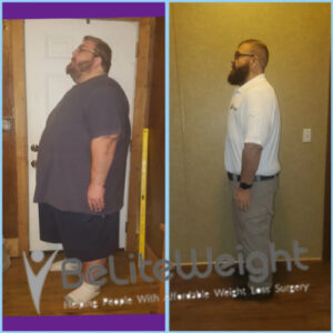 David R= Before And After Gastric Bypass Surgery