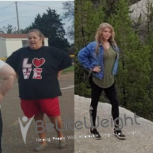 Gastric Bypass Revision Before And After