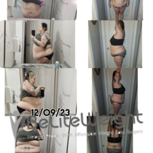 Jessica A= Gastric Bypass Before And After Pictures Skin