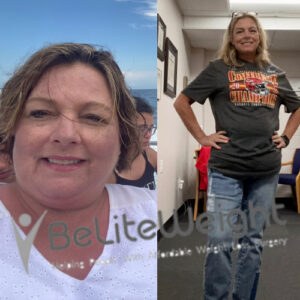 Before And After Gastric Bypass Surgery