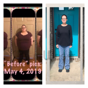 Mini Gastric Bypass Before and After Photos