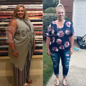 Gastric Bypass Revision Before And After