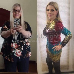 Before And After Gastric Bypass