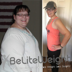 Before And After Gastric Bypass Surgery