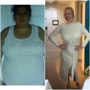 Gastric Bypass Revision Before And After Photos