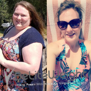 Shelby H= Gastric Bypass Surgery Before And After