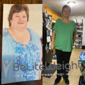 Gastric Bypass Before And After Photos