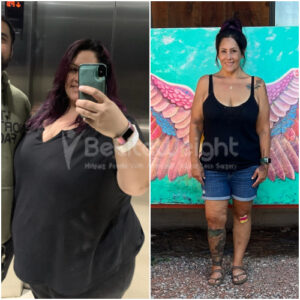 Sarah F- Gastric Bypass Before and After