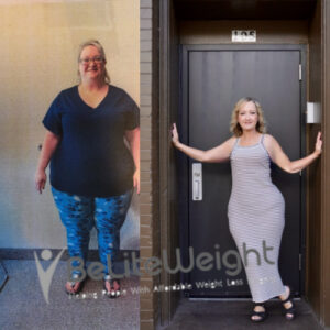 Traci W= Gastric Bypass Before And After Pictures Skin
