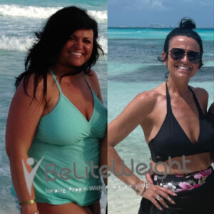 Sydney C= Before And After Gastric Bypass Surgery