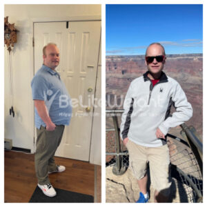 Tad S = Before And After Gastric Bypass