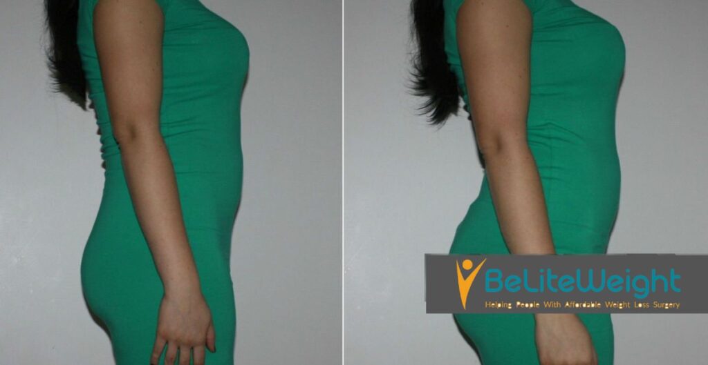 BBL After 10 Years Pictures
