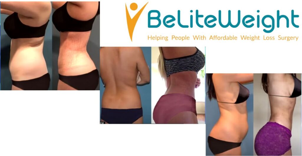 How the Body Reacts to a Brazilian Butt Lift (BBL) 