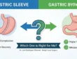 Gastric Sleeve
