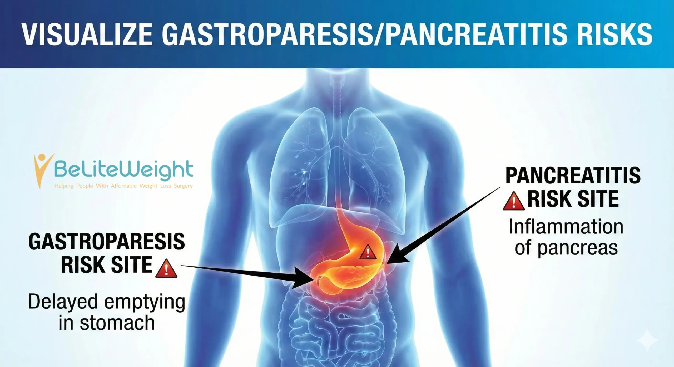 Gastroparesis-Pancreatitis - BeLiteWeight