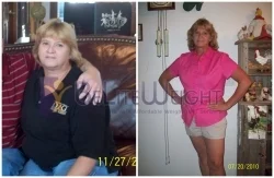 Weight Loss Surgery before and after Patient - I am doing great after my surgery. I had tried every diet program that came...