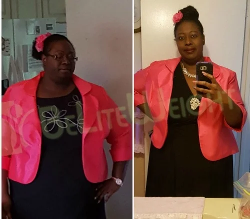 weight loss surgery vsg vertical gastric sleeve bypass lap band before and after &