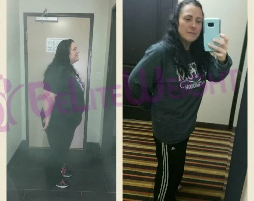 weight loss surgery before and after gastric sleeve bypass band vsg vertical