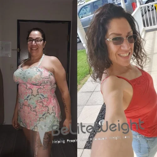 Weight Loss Surgery Gastric Sleeve before and after