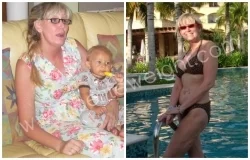 Lap Band Revision Surgery