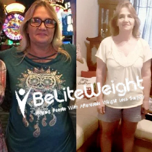 Band to Mini Bypass Revision before and after Patient - I have done very well so far and I have had no problems. I weight...