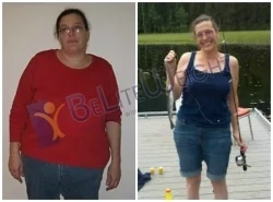 Weight Loss Surgery before and after Patient - Disclaimer: I work for BeLiteWeight but I'm doing a testimonial because I had surgery, lost...