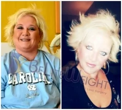 Before and After Weight Loss Gastric Sleeve Surgery
